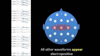 EEG Montages [upl. by Waxman]