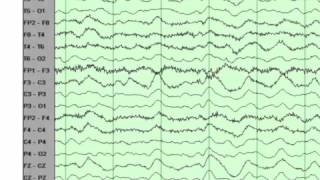 EEG basics [upl. by Pentheas]