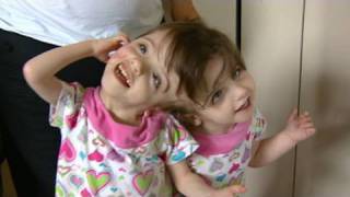 Conjoined Twins Twin Girls A Medical Wonder [upl. by Aikkan]