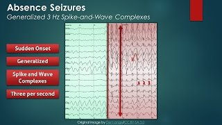 Focal EEG Abnormalities 2 [upl. by Ayhtak933]